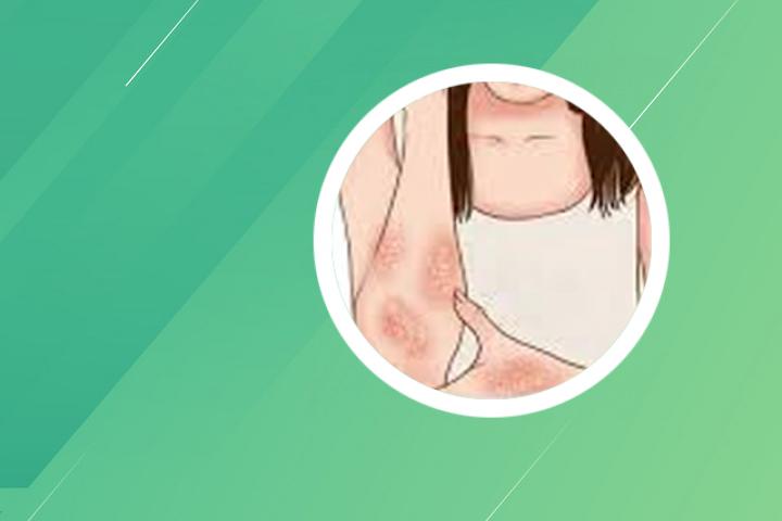 中医治疗银屑病特效方