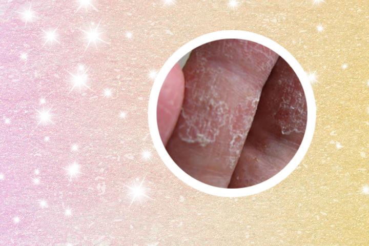 健康卫视银屑病