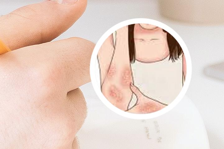 小孩会得银屑病吗