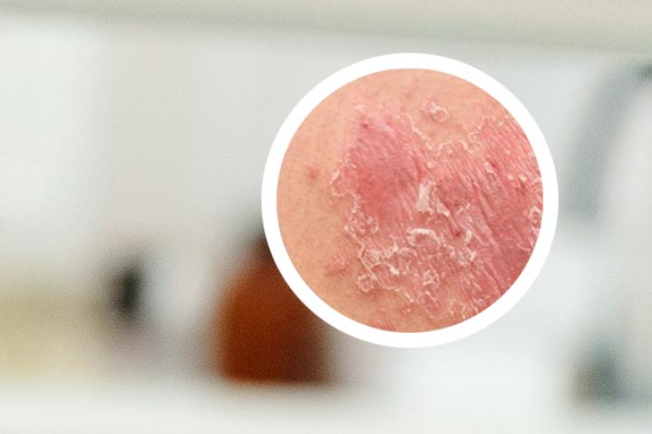 银屑病生物制剂阿达木单抗