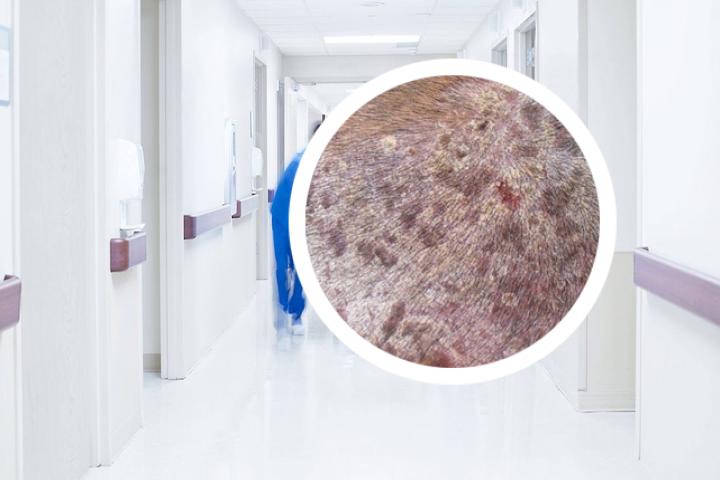 银屑病生物制剂价格表