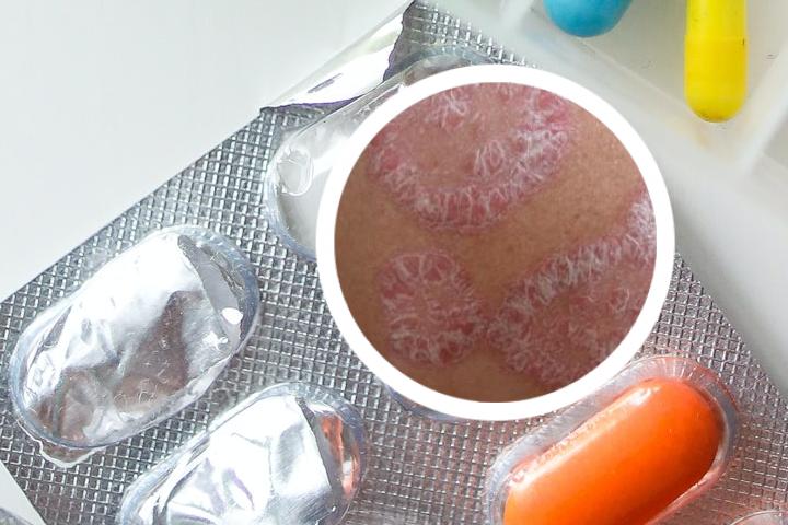 中药防治牛皮癣的特效药