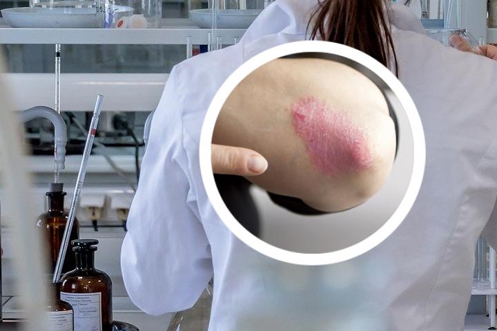 银屑病可以练肌肉吗