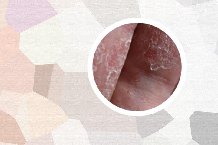 银屑病可以用艾草洗吗