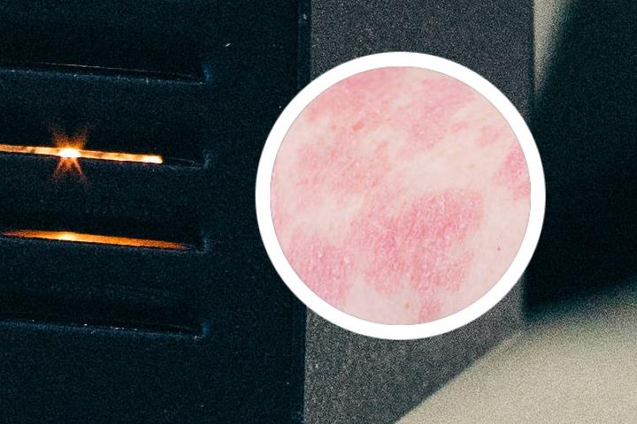银屑病关节炎诊治指南