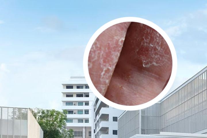 银屑病患者吃什么药