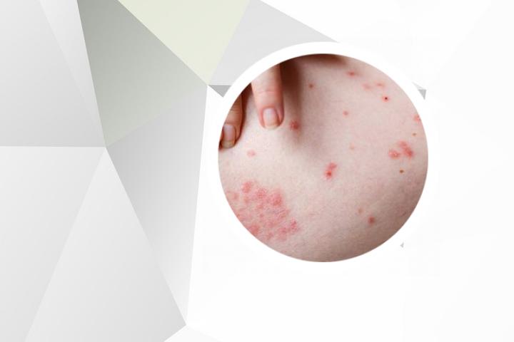 使用银屑病生物制剂外用口服能否有效治疗银屑病