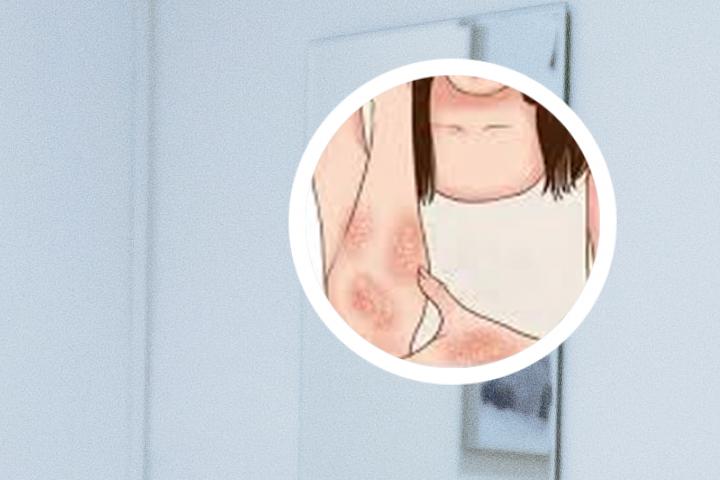 银屑病几个月能治愈
