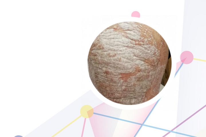 中药药浴治疗牛皮癣配方