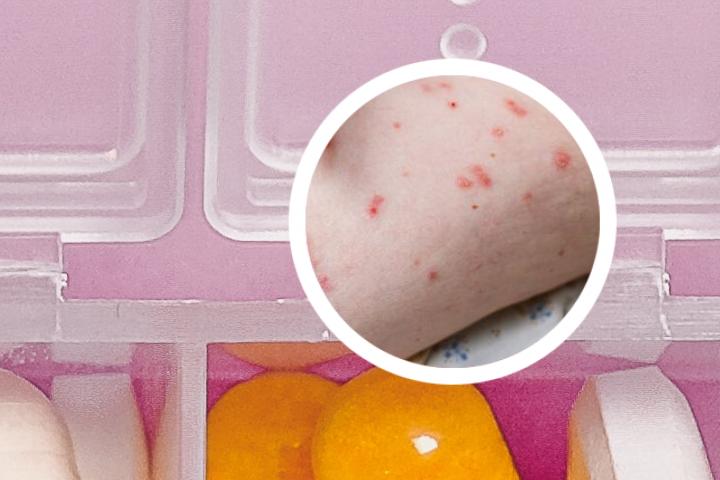 红皮型银屑病导致大腿肿有什么治疗方法