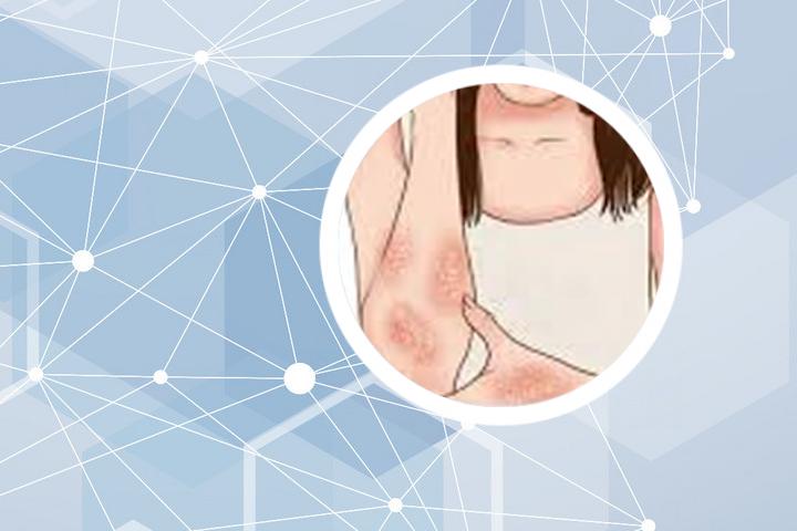 银屑病病人会得癌症吗