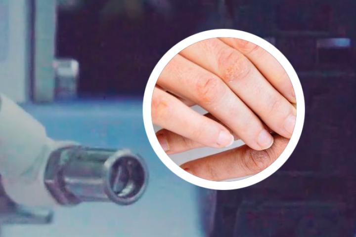 锻炼六个治好银屑病