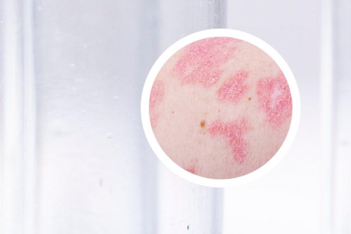 什么药水能治银屑病病毒