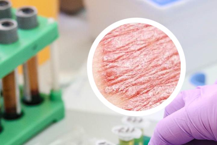 中国银屑病流行病学特征
