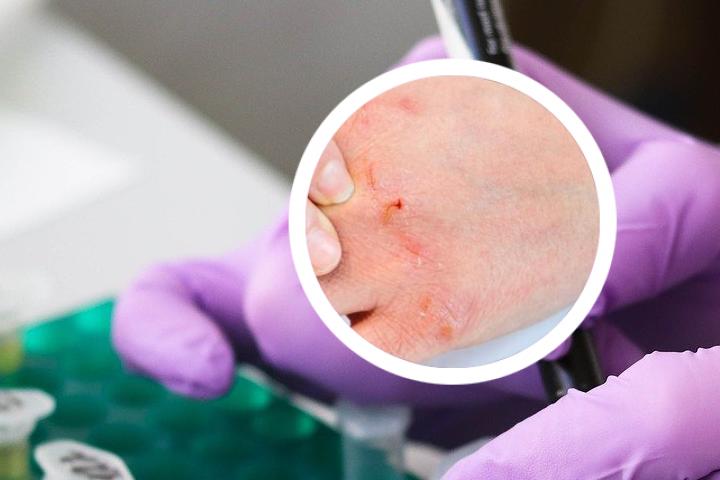 冶疗银屑病最新生物制剂