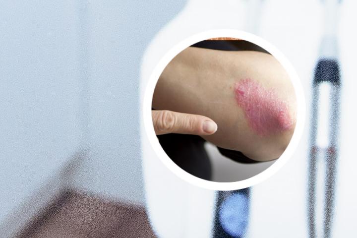 怎么区分银屑病与副银屑病