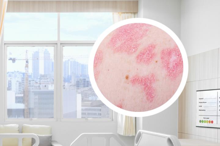 烟袋油子治疗银屑病