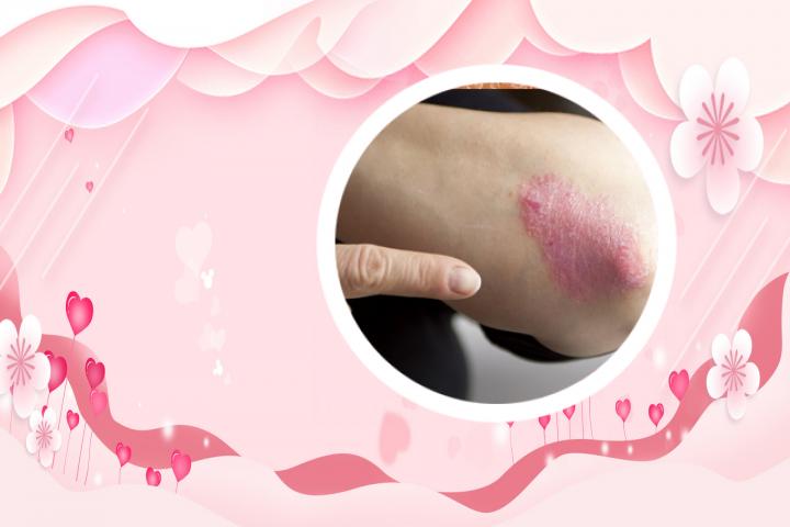 维生素A对银屑病有效吗