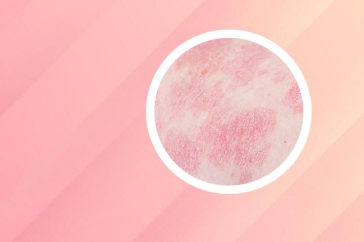 牛皮癣的病人忌口哪些