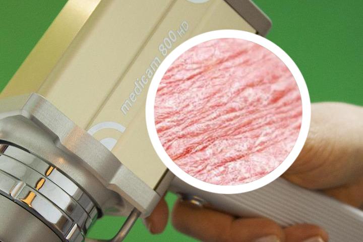 甲氨蝶呤治疗银屑病用法
