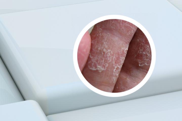 银屑病用达克宁有用吗