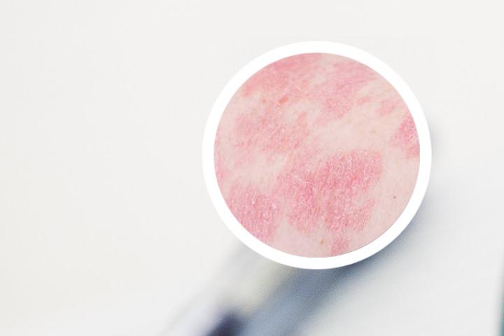 银屑病引起手掌麻木吗