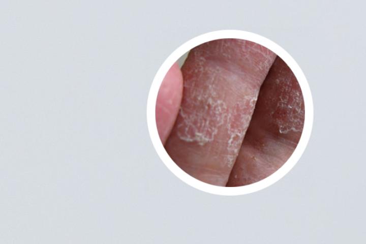 孩子银屑病可以打疫苗吗