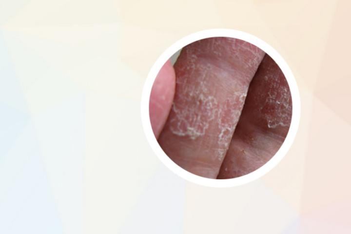 牛皮癣与情绪的关系