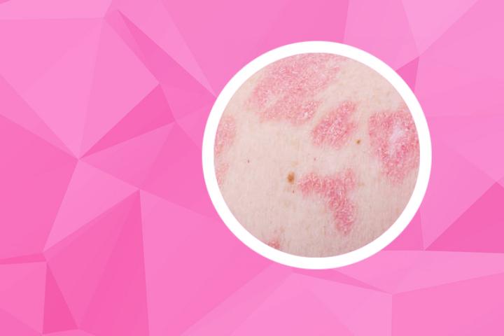 银屑病指甲红肿