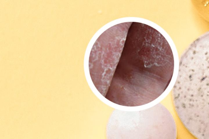 轻度银屑病患者可以吃海鲜吗