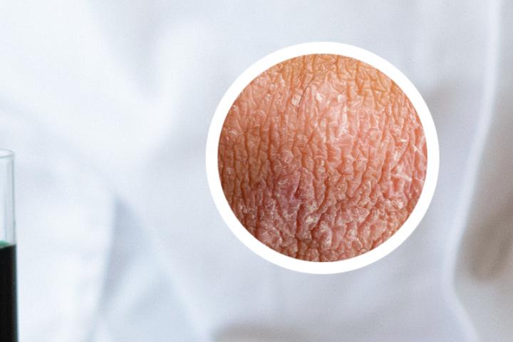 生物制剂可以用于银屑病治疗吗