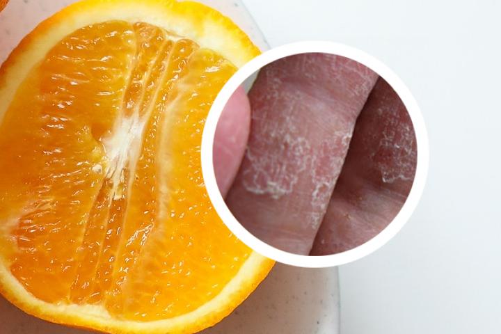 甲氨蝶呤治疗银屑病正确使用方法