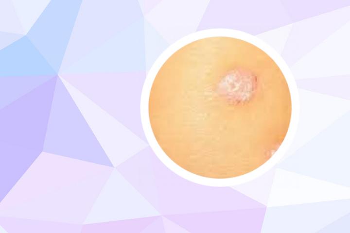 八珍丸能治银屑病吗 银屑病吃什么中药好