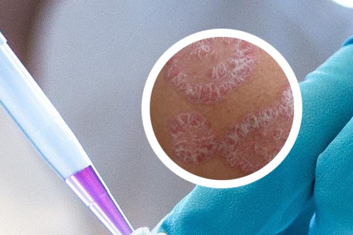 冶疗银屑病最新生物制剂
