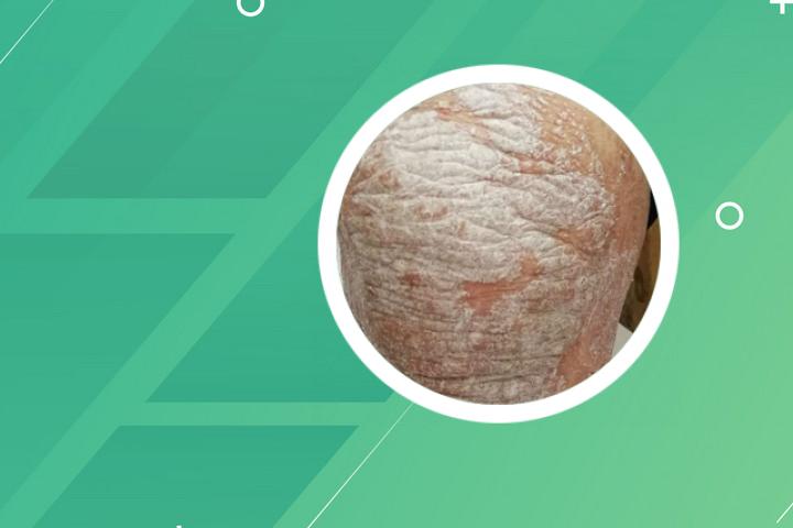 头上银屑病红点图片大全