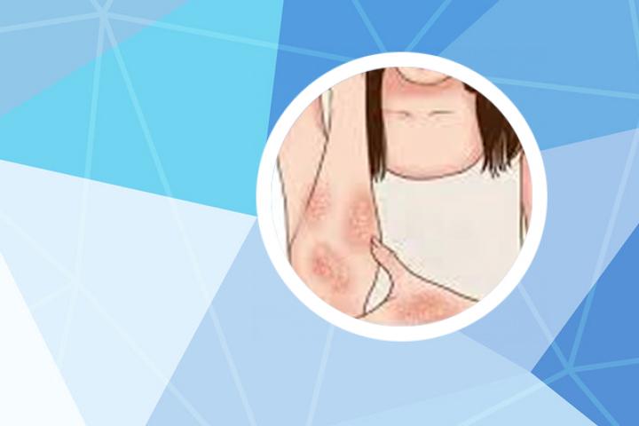 杉木叶治银屑病