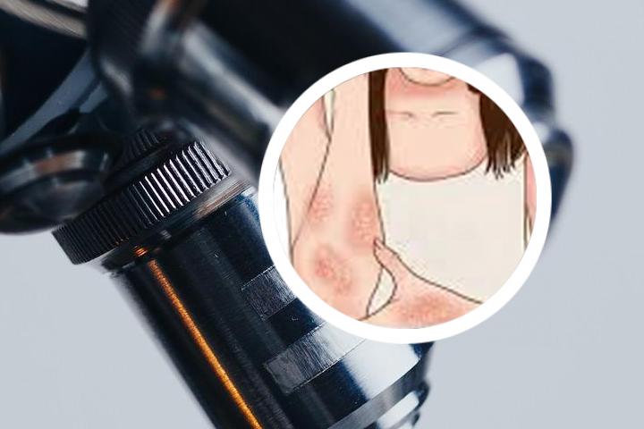 9小孩得银屑病
