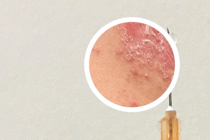 银屑病光疗后能洗澡吗