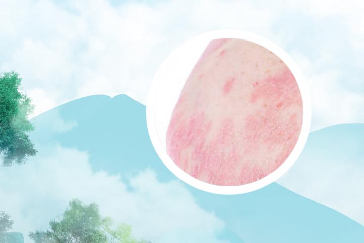 银屑病治疗的黄色药片有效吗