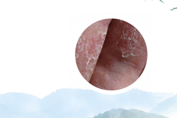 确诊银屑病需要做什么检查