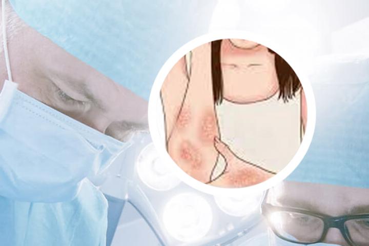 为什么我的皮肤会痒但没有银屑病