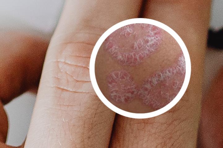 牛皮癣宝宝治不好吗