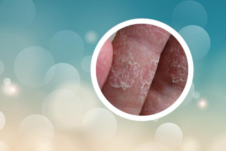 自血疗法治疗银屑病有用吗