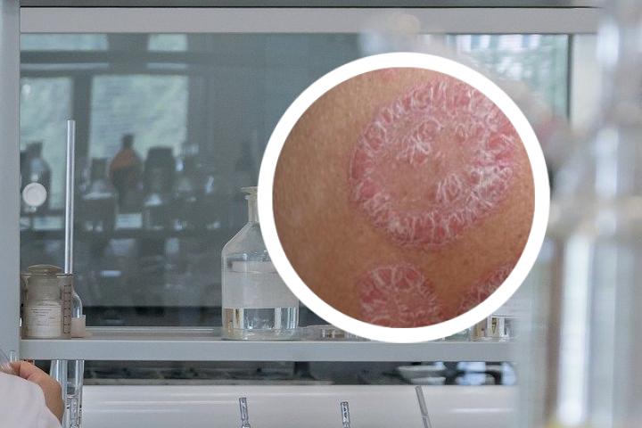 熬什么水泡澡治银屑病