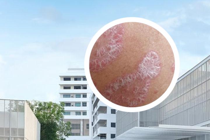 点滴型银屑病6个月才消退