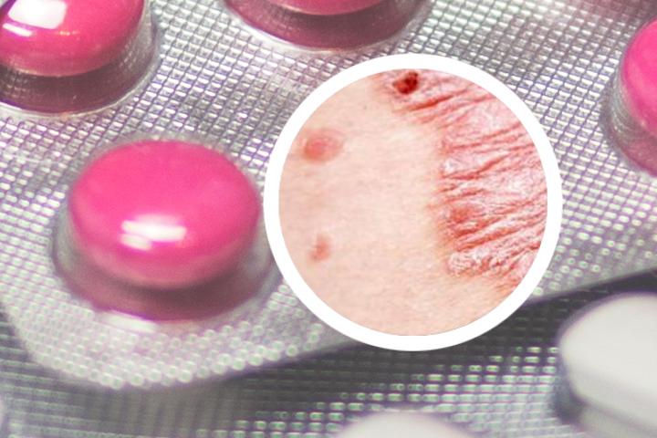 维生素c治疗银屑病