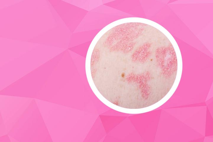 阿普斯特银屑病关节