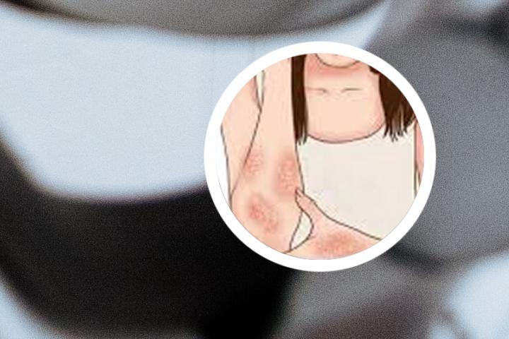 银屑病走路关节不适