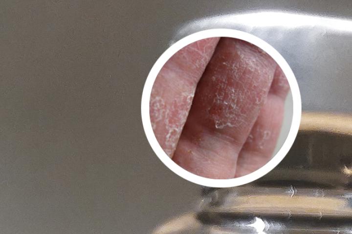 牛皮癣健康大礼包