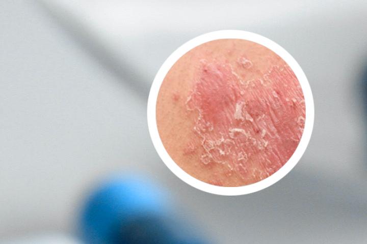 hiv 银屑病